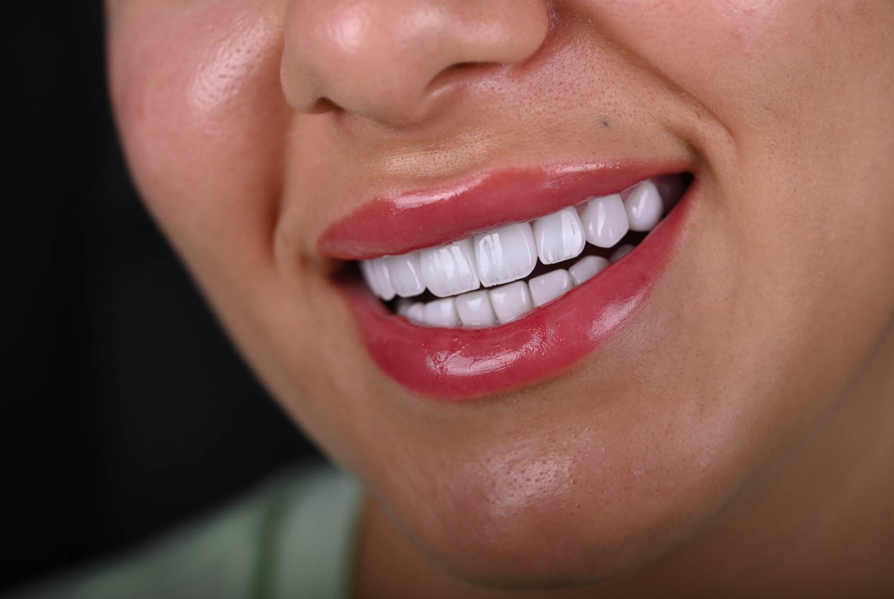 Porcelain Veneers Dubai - Custom Smile Design and Cosmetic Dentistry at Royal Villanova Center