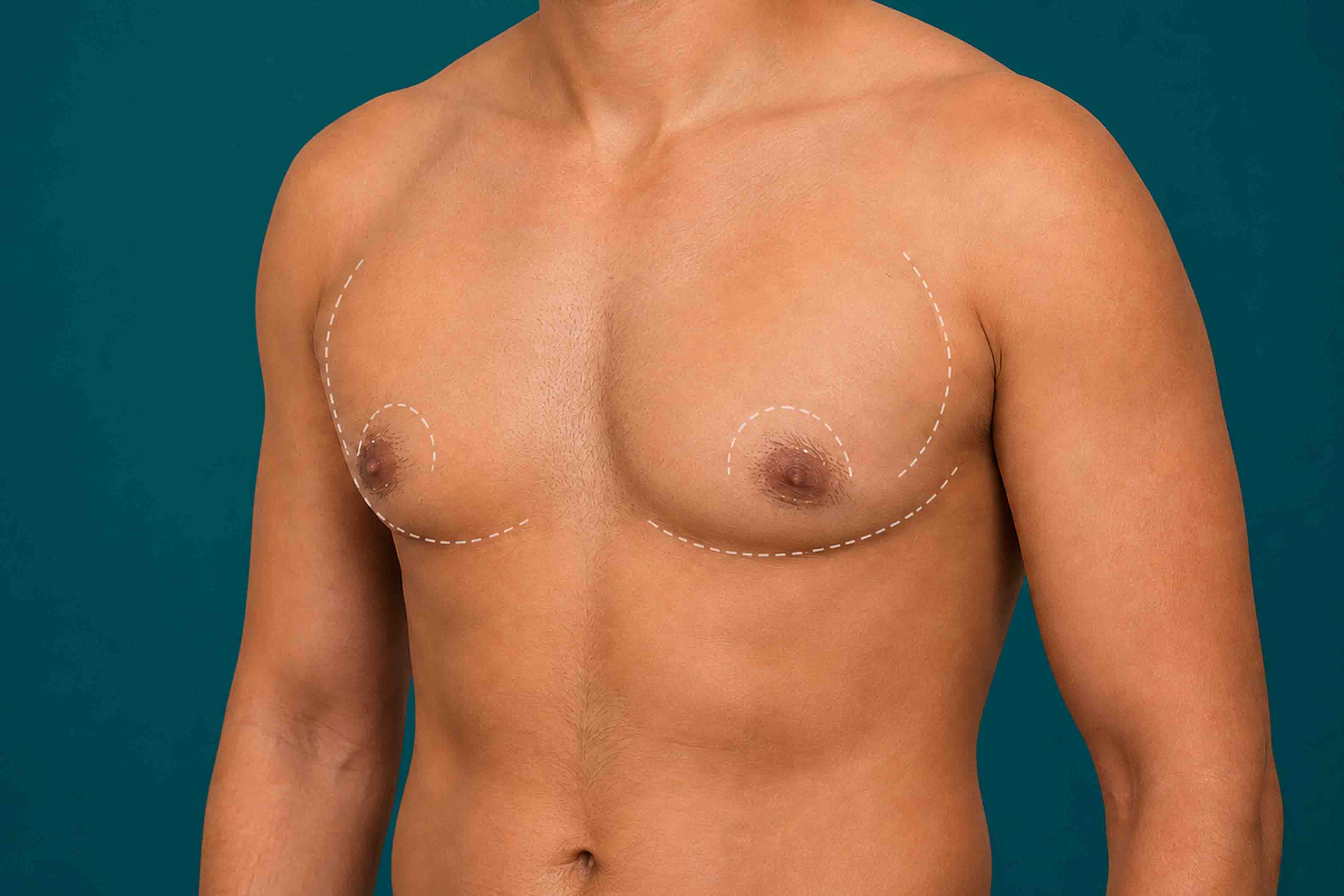 Gynecomastia Male Breast Reduction Dubai